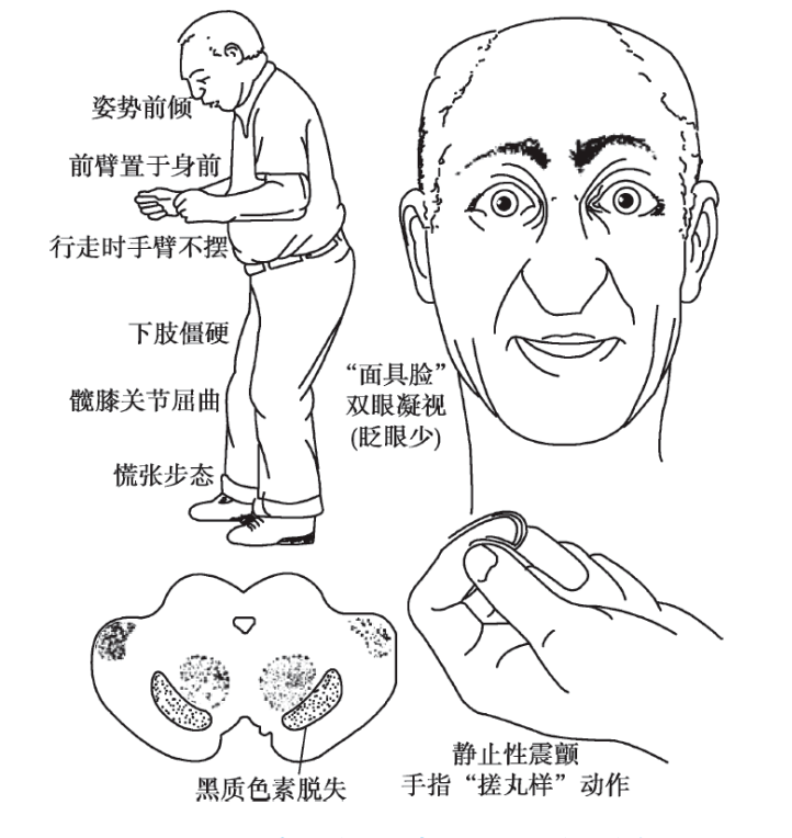 我国科研人员开发可穿戴监测系统为帕金森病早期干预提供可能